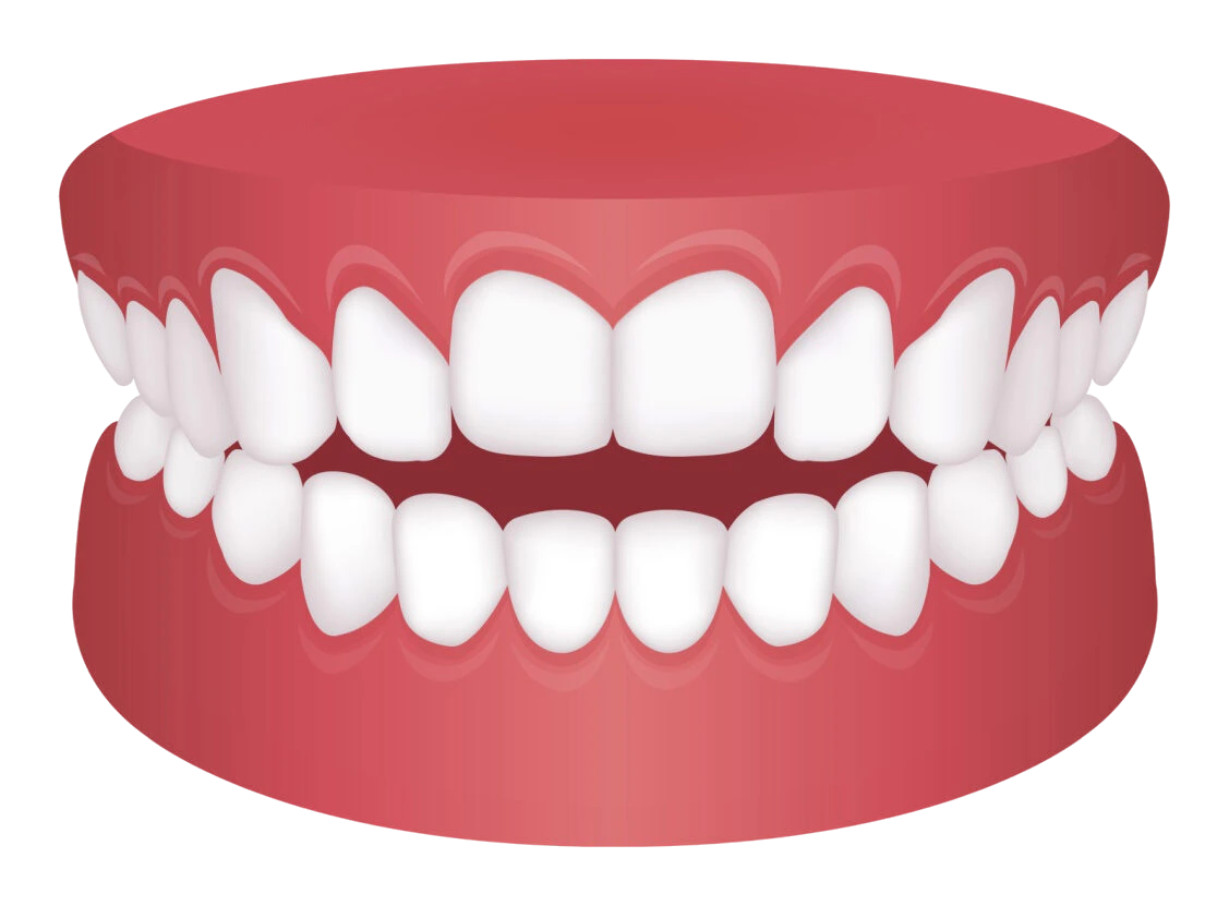 Open Bite